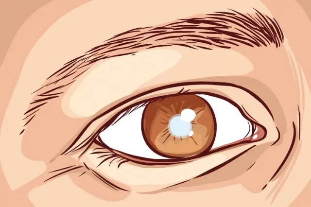 白内张手术后干眼症怎么办？