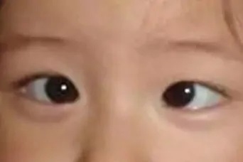 儿童为什么会斜视？北京眼科医院